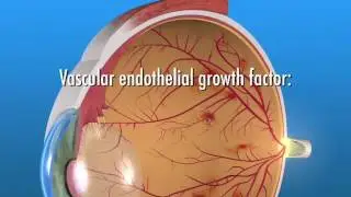 retina specialist the villages florida