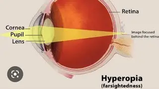 Farsightedness / (hyperopia) in Marathi || 👁️ eye defects|| vision correction|| use of convex lens