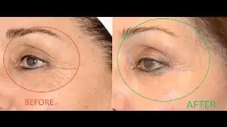 8 Tips To Get Rid Of Crow&rsquo;s Feet