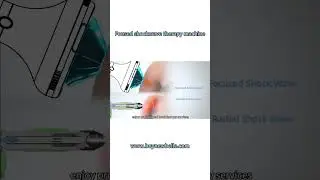 Discover the Power of Precision &ndash; B63 Focused Shockwave Machine