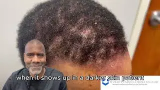 Is It Scalp Psoriasis or Seborrheic Dermatitis? | Dermatologist Explains