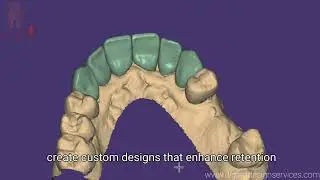 Exocad : Designing Post and Core For a Dental Lab