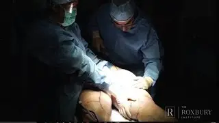 Erin's Lipedema Story: Part 2