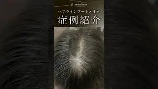 透けている頭皮を一瞬で埋める！ヘアラインアートメイク#アートメイク#shorts#メディカルブロー