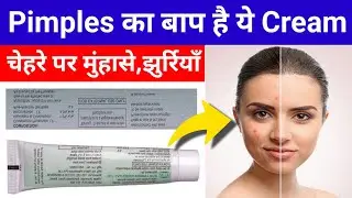 This cream is the father of pimples. Eliminate pimples, acne and freckles from the face completel...