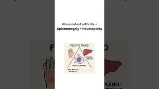 Felty syndrome triad #medical #usmle #neetpg #medicalshorts #shorts