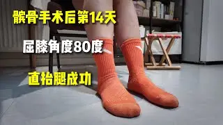髌骨术后第14天｜直抬腿成功｜屈膝达80度