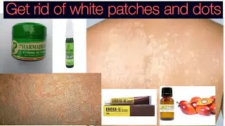 How to get rid of white dots and white patches on the skin