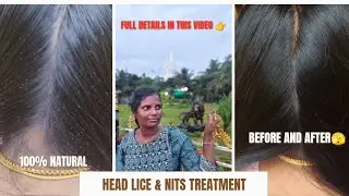 How To treat lice on hair😳| Lice & Nits Treatment in Our Service| 100% Natural @JasminesBeautylounge