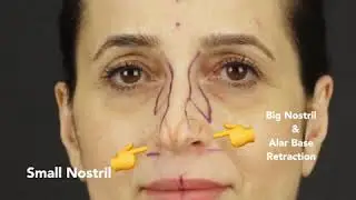 Nose Job Before and After Video