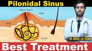 What is Pilonidal Sinus | Tailbone Infection Treatment | Treatment of Wounds Below the Waist by D...
