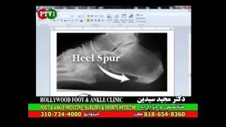 Short toes, Hollywood Foot & Ankle,12/ 25/2014