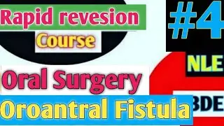Rapid revesion course of oral and maxillofacial surgery /Oroantral communication /Oroantral fistula