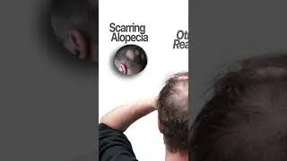 ❌ Who Can&rsquo;t Do Hair Transplant? Even Prabhas Didn&rsquo;t! 🤯💇&zwj;♂️