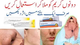 Contractubex Gel | Skinoren Cream Uses in urdu | How to Remove acne scar| Dark spots | Pimple marks