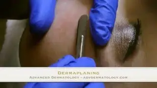 Dermaplaning to exfoliate skin at Advanced Dermatology