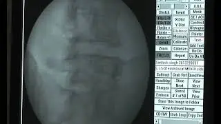 Lumbar Discography Dept of Anesthesia, SGPGIMS, Lucknow
