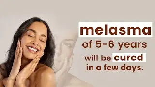 Melasma & Modern Homeopathy Treatment | Permanent Solution for Facial Dark Spots #melasmatreatment
