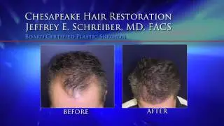 Baltimore Hair Transplant Video