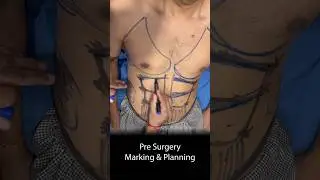 Six Pack Abs Surgery Process | 6 Pack Abs Surgery Result #shortsfeed