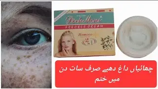 Best Freckles Removal Cream || Dark Spots || Sunspots|| dochmens Cream Uses|| Results|| Benefits