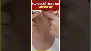 भारत पहुंचा Monkey Pox वायरस, आया पहला केस | WHO | Mpox case in India