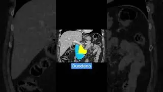 Anatom&iacute;a normal de duodeno Pancreas por #tomografia 🔥