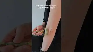 Narbenentst&ouml;rung &ndash; Die besten Tipps!