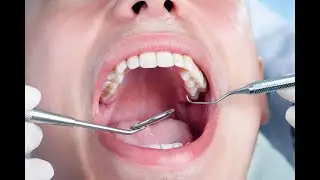 How To Restore Healthy Gums And Teeth | Prodentim Review | Best Oral Probiotic ?