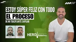 Implante capilar en Colombia: antes y despu&eacute;s real | Testimonio HERO