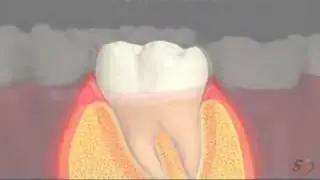 Perio - Probing.FLV