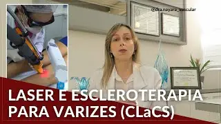 LASER e escleroterapia para VARIZES - Dra. Nayara Cioffi Batagini - Cirurgia Vascular e Endovascular