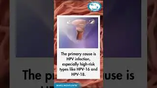 Cervical Cancer: A Silent Threat to Women's Health