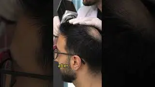 Getting a Hair Transplant - Part 2