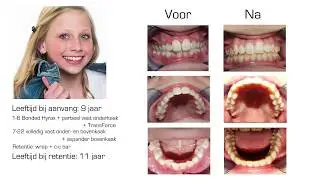 Voor en Na behandeling 14