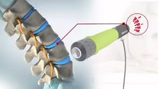New Shockwave Therapy for Sciatica and Low Back Pain In #montreal