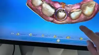 Подготовка зуба под керамическую коронку eMax на CEREC #стоматология #пломба #имплант #кариес