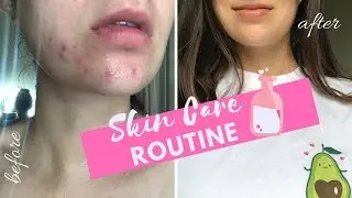 How I Cleared My Skin Naturally (Non-toxic Acne Treatments)