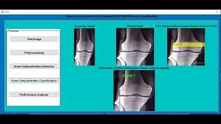 Knee Osteoarthritis Detection and Classification Using X-Rays | Deep Learning | MATLAB IEEE Project