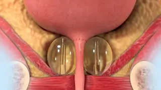 ProACT Animation for Patients