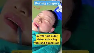 The 53 year old sister has a face full of skin pulling, and there will be no traces after recovery