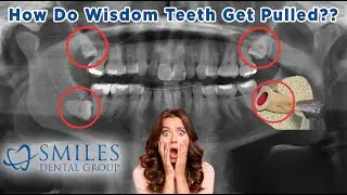 How Are Wisdom Teeth Removed? (2025) Watch this video BEFORE you get your surgery!