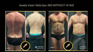 Liposuction | Before & After By Dr Saurabh Jain | Real Patient Results-@aestheticandcosmeticsurgeons