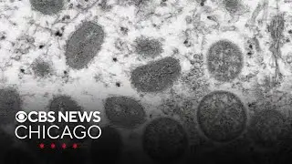 CDC confirms new form of mpox found in California