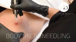 Body Microneedling Treatment - Holistic Beauty