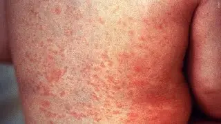 New measles map shows vaccination rate, risk for each US county, zip code
