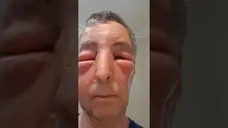 Bee bite finny face #shortvideo