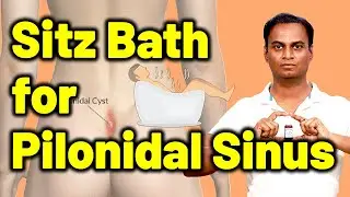 Sitz bath or Tub bath for Pilonidal Sinus Cyst Abscesses | Treatment Cure Medicine | Dr. Bharadwaz