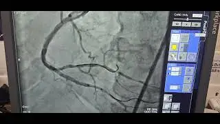 TAP technique- RCA bifurcation stenting