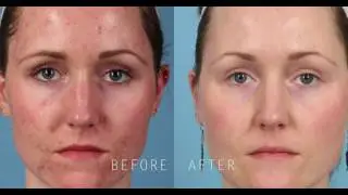 PicoSure Focus Skin Rejuvenation for Treatment of Acne Scars